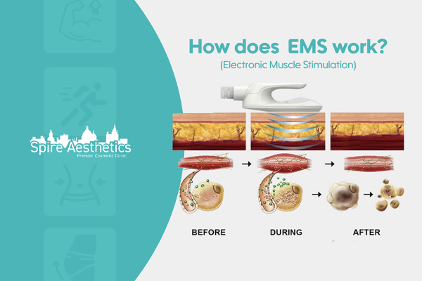 EMS treatment for post pregnancy weight loss treatment