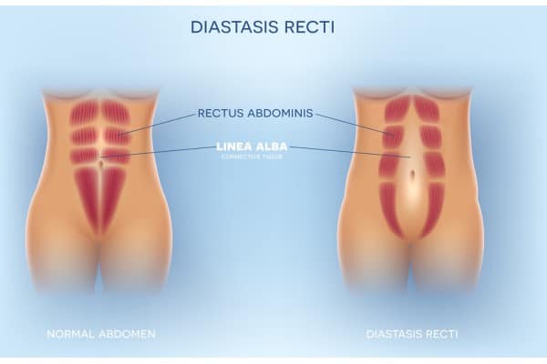 What Non-Surgical Options Are Available for Diastasis Recti ?