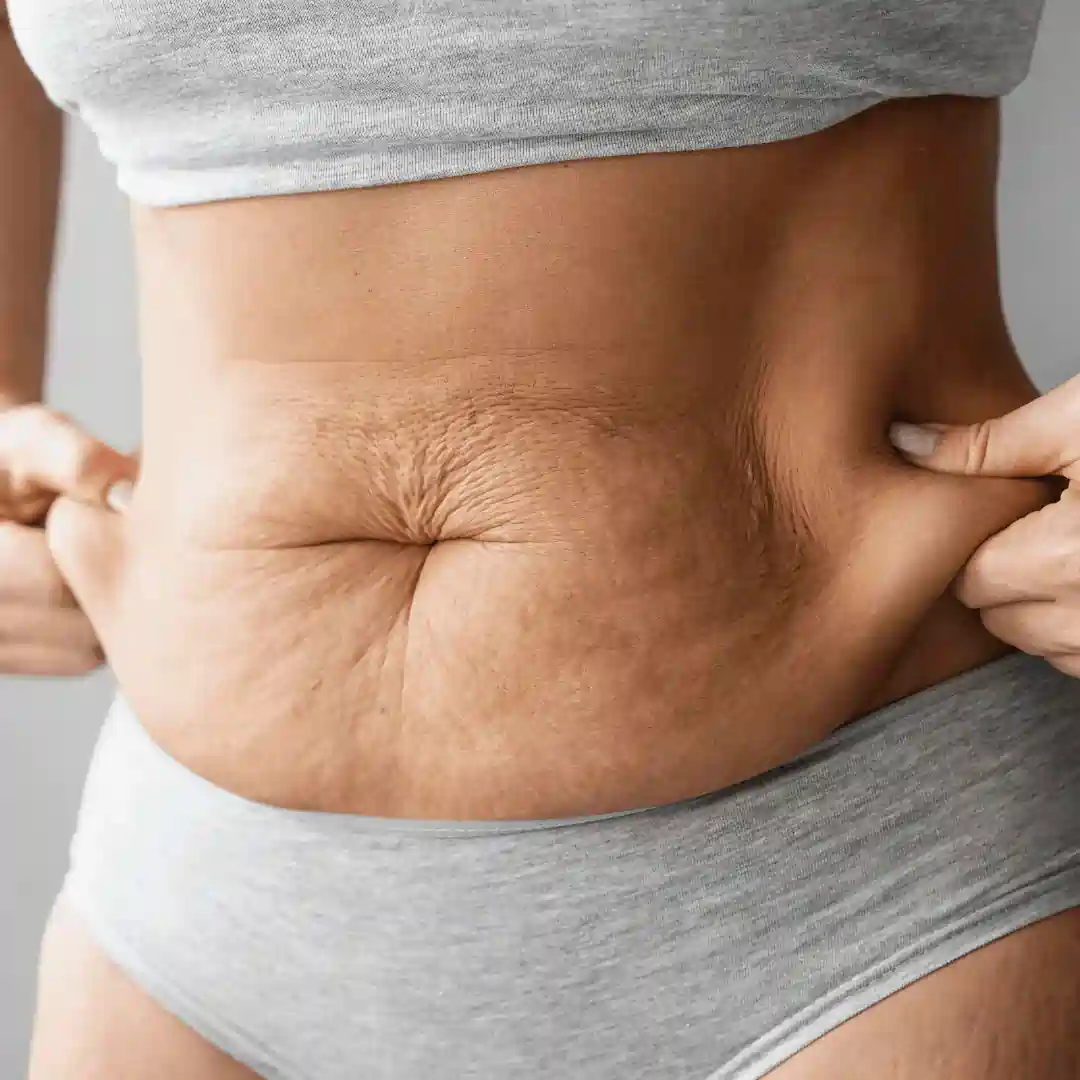 Is It Normal to Have Loose Skin After Pregnancy ?