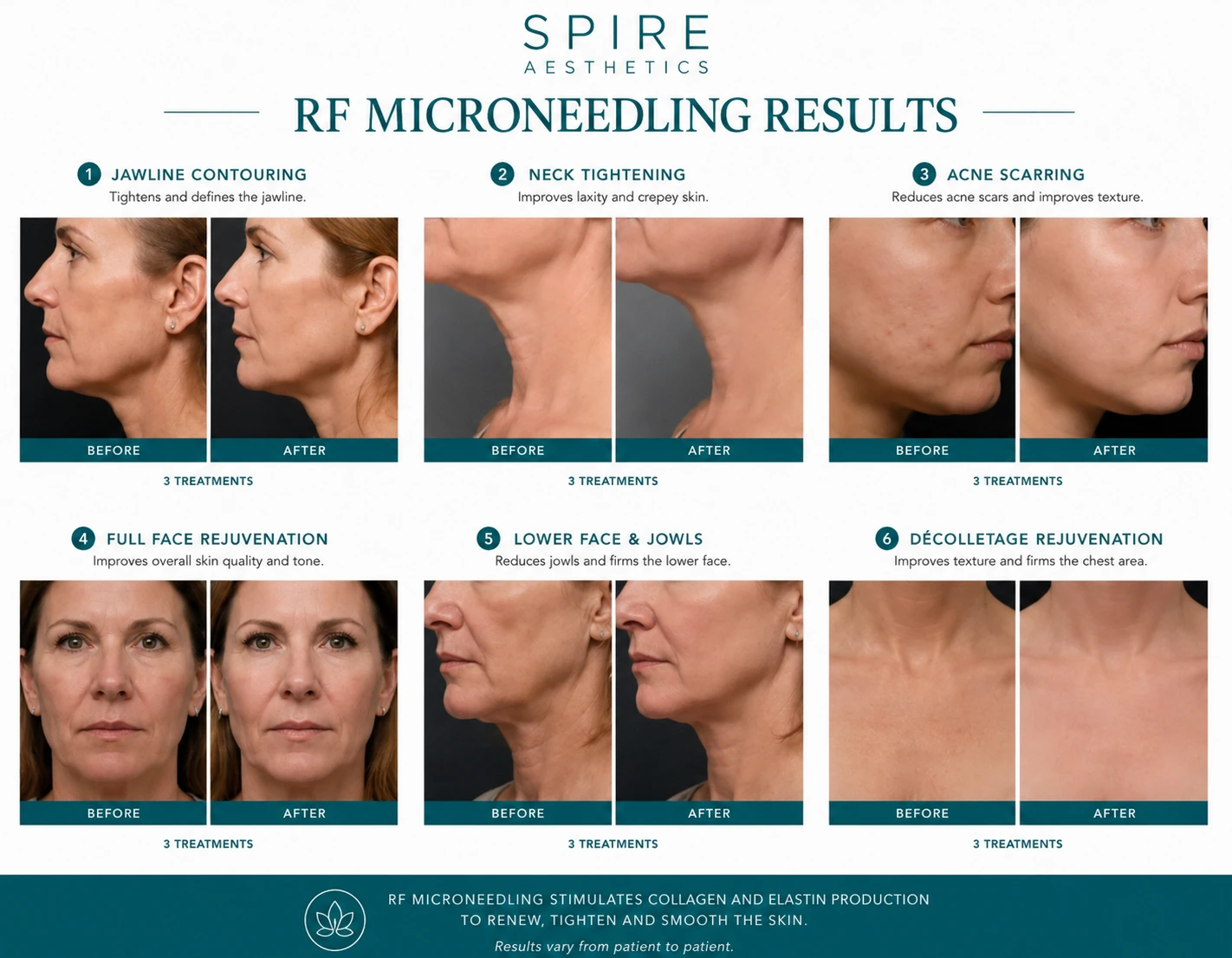 RF Microneedling Skin tightening results