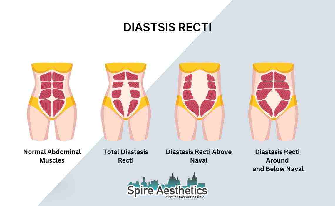 Is Non-Surgical Diastasis Recti Treatment Right for You? Common Concerns Answered